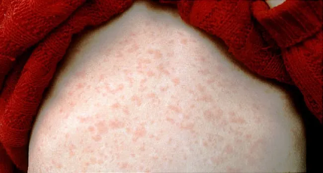 could-us.-measles-cases-break-a-record-this-year?-what-to
know