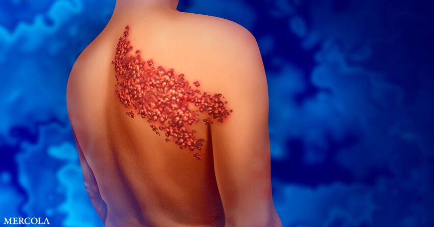 how-to-tell-the-difference-between-herpes-and
shingles