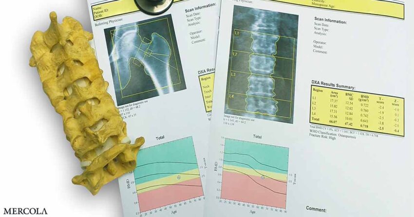 the-great-osteoporosis-scam